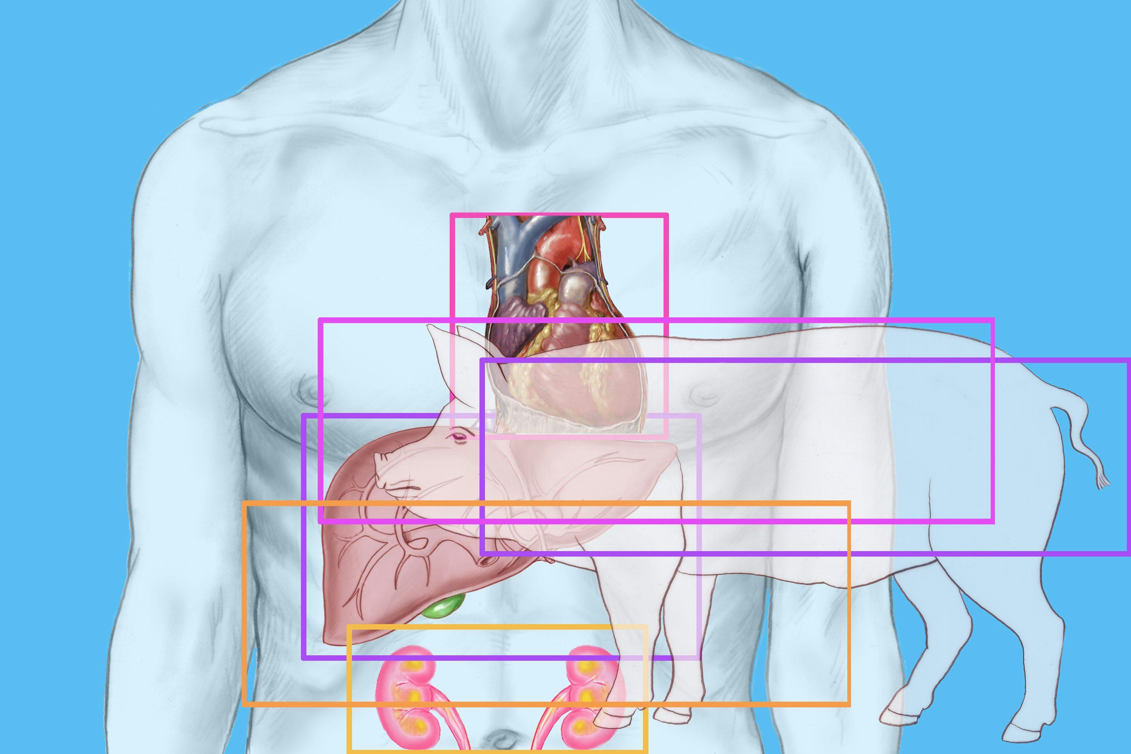 An illustration showing a human torso and a pig to reference xenotransplantation.